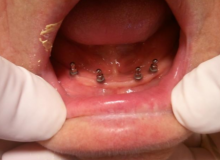 Implantes dentales_Clinica Dental Fuencarral_Caso 1_1