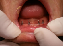 Implantes dentales_Clinica Dental Fuencarral_Caso 1_2