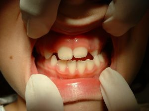 Odontopediatria_Clinica Dental Fuencarral_Caso 2_1